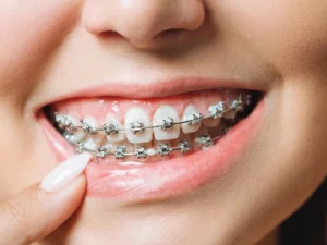 แพ็กเกจจัดฟันแบบดามอน (Damon)