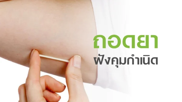 ถอดยาฝังคุมกำเนิด
