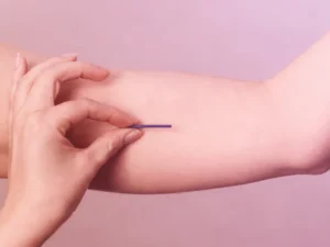 คุมกำเนิดแบบฝัง