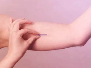 คุมกำเนิดแบบฝัง