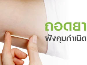 ถอนยาฝังคุมกำเนิด
