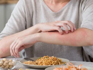 ตรวจคัดกรองภูมิแพ้อาหาร 20 ชนิด